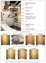 Camera-based photoplethysmography (cbPPG) to measure the change in perfusion after local negative pressure therapy